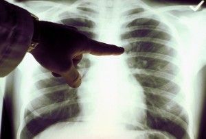 A lump on lung: 'wait and see' or surgery?